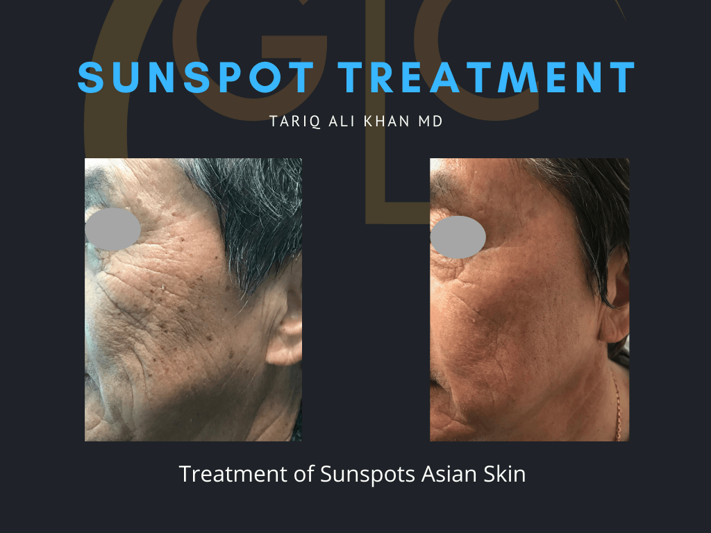 Gentle Care Laser Tustin & Long Beach Before and After picture - Sunspot treatment